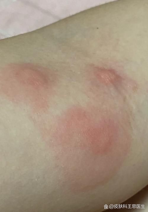 如何判斷自己是否對鱘龍魚過敏？（———醫學診斷鱘龍魚過敏診斷流程詳解）