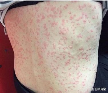 如何判斷自己是否對鱘龍魚過敏？（———醫學診斷鱘龍魚過敏診斷流程詳解）