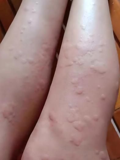 如何判斷自己是否對鱘龍魚過敏？（———醫學診斷鱘龍魚過敏診斷流程詳解）