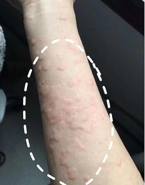如何判斷自己是否對鱘龍魚過敏？（———醫學診斷鱘龍魚過敏診斷流程詳解）