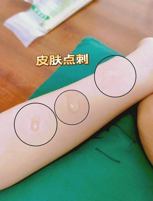 如何判斷自己是否對鱘龍魚過敏？（———醫學診斷鱘龍魚過敏診斷流程詳解）