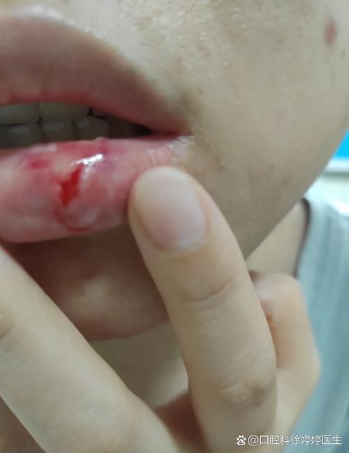 如何判斷龍魚嘴撞豁是否嚴重？（——權威分級標準與實操判斷龍魚嘴撞豁嚴重程度）