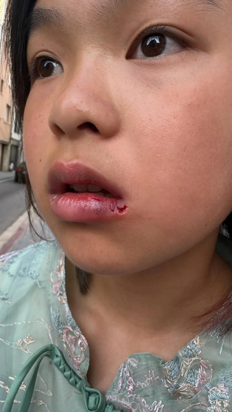 如何判斷龍魚嘴撞豁是否嚴重？（——權威分級標準與實操判斷龍魚嘴撞豁嚴重程度）