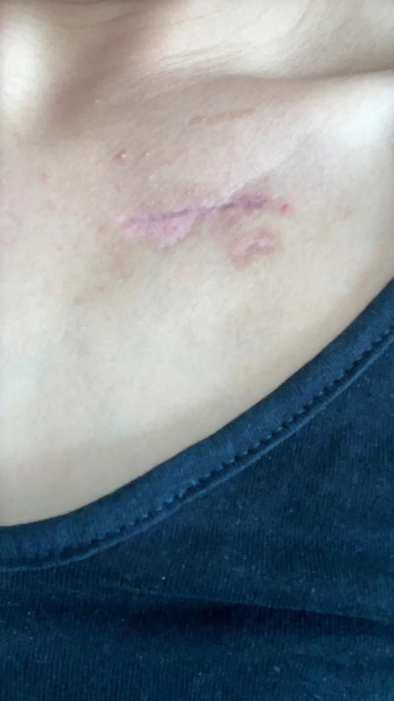 龍魚爛鰓蓋手術后如何護理（龍魚爛鰓蓋手術后護理）