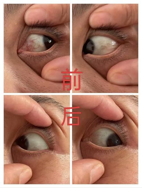 能否提供魚白眼病治療前后的對比圖（如何判斷魚白眼病治療期間需要喂食嗎）