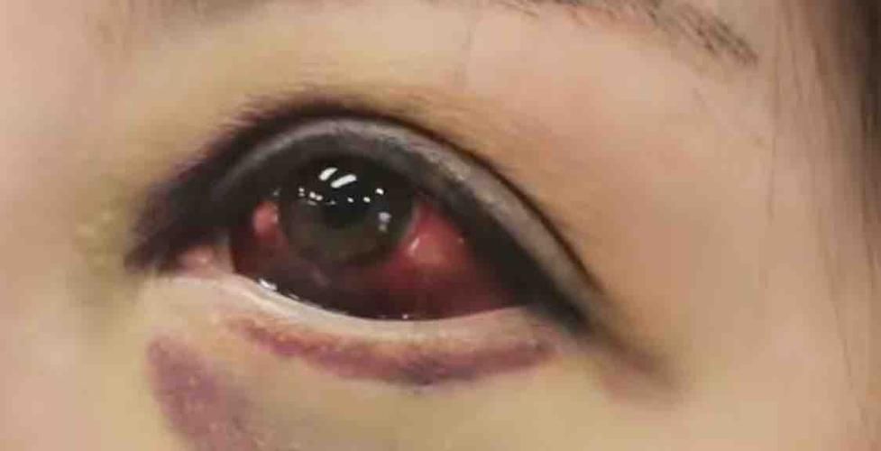 魚類常見(jiàn)細(xì)菌性疾病，renibacteriumsalmoninarum細(xì)菌性疾病科普