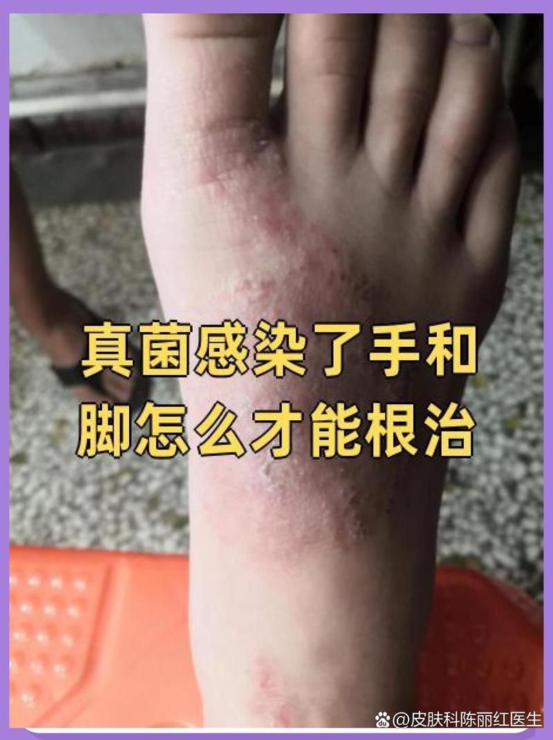 手部真菌感染如何治療，手部真菌感染怎么辦