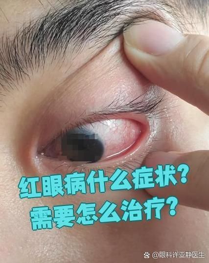 銀龍魚紅眼病的癥狀有哪些？，關于銀龍魚紅眼病
