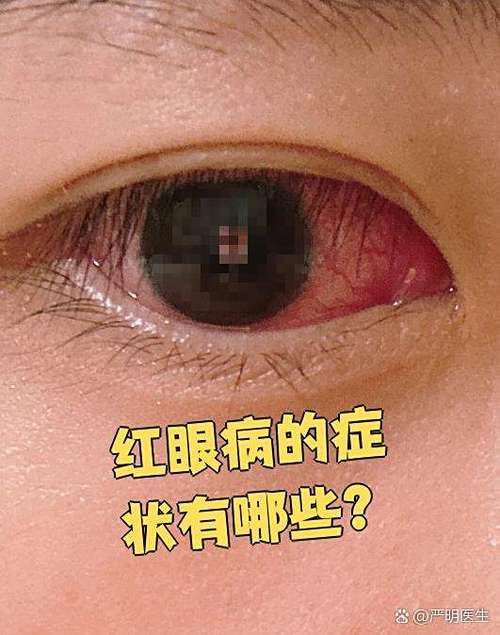 銀龍魚紅眼病的癥狀有哪些？，關于銀龍魚紅眼病