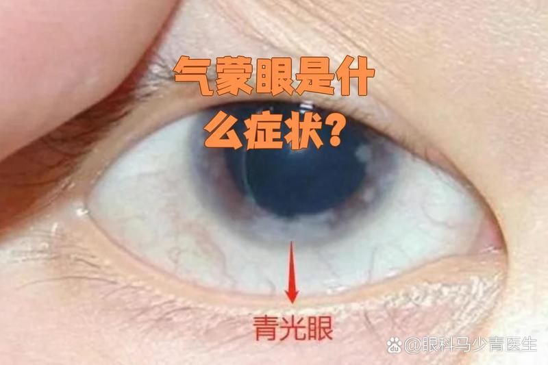 氣蒙眼如何快速緩解，“氣蒙眼”和“詳解“氣蒙眼”要求1000字說明和配圖