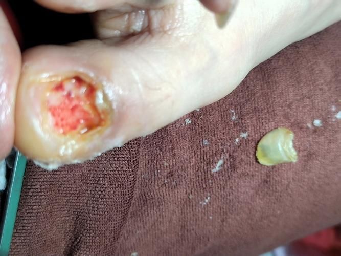 被龍魚咬傷后需要多久恢復(fù)，被龍魚咬傷后多久可以洗澡