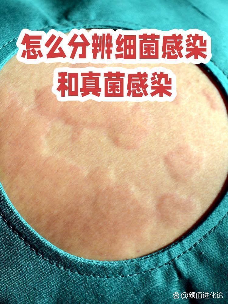 真菌和細菌感染的癥狀有何不同，——真菌感染和細菌感染的區別