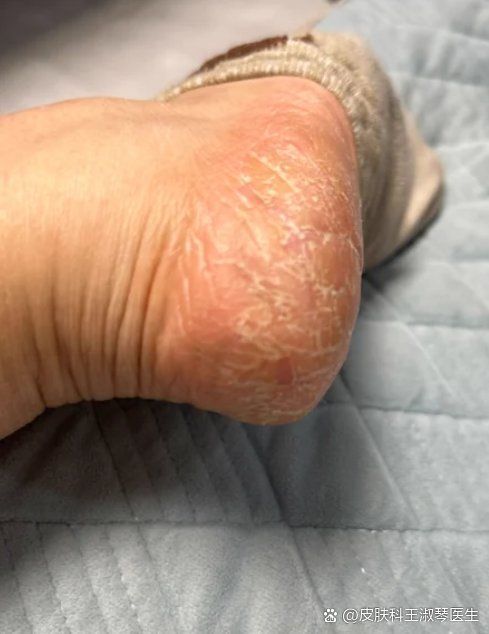 真菌在手上存活多久會死亡，「手部真菌在手上存活多久會死亡 真菌在手上存活多久會死亡，「手部真菌在手上存活多久會死亡 龍魚百科 第3張