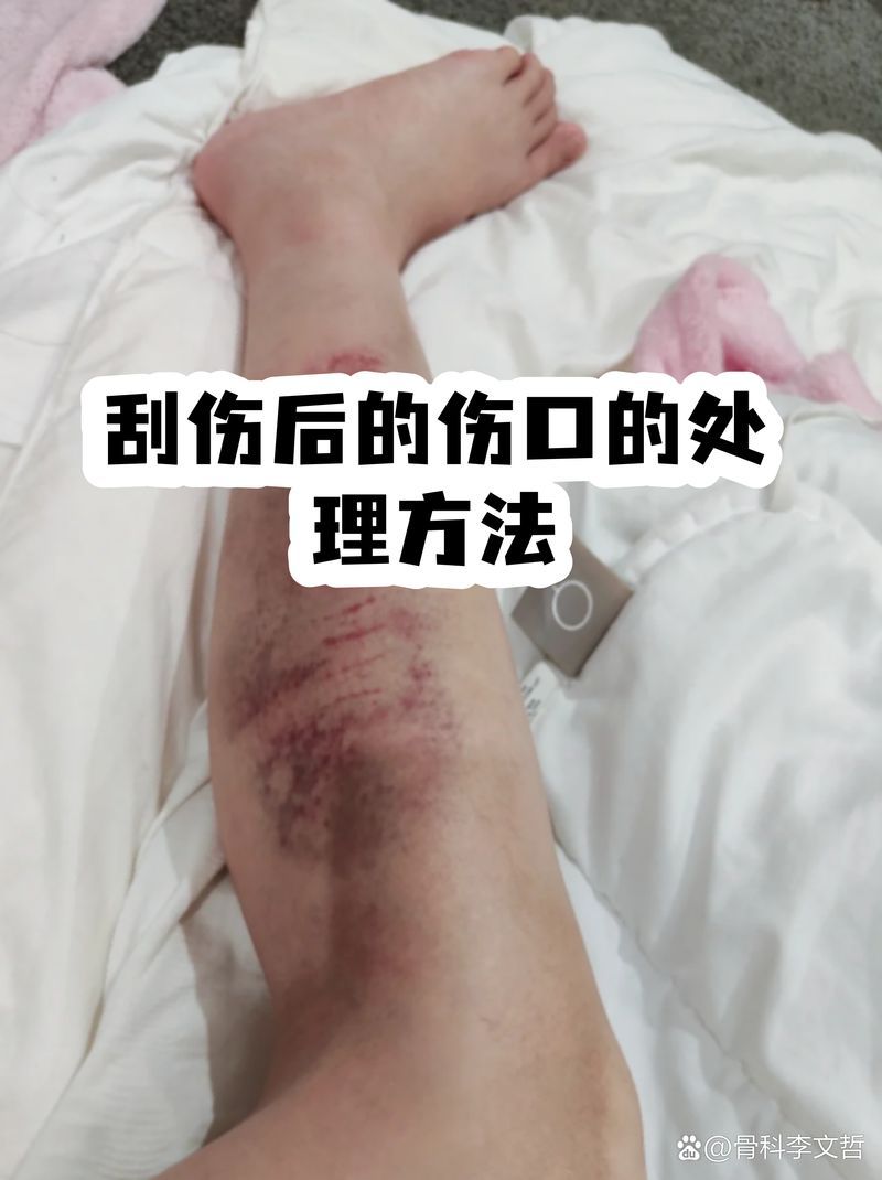 物理刮傷后如何護理，刮傷后怎么辦 物理刮傷后如何護理，刮傷后怎么辦 龍魚百科 第2張