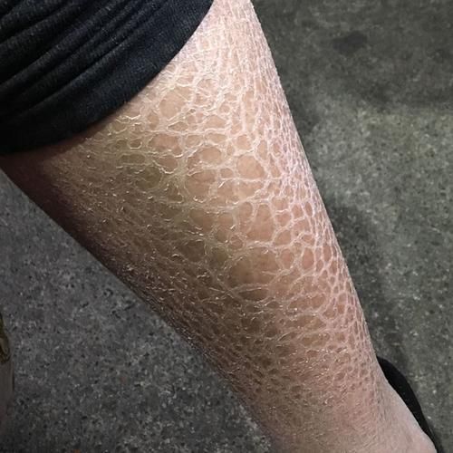 魚鱗皮膚病圖片，如何區分不同類型的魚鱗病？