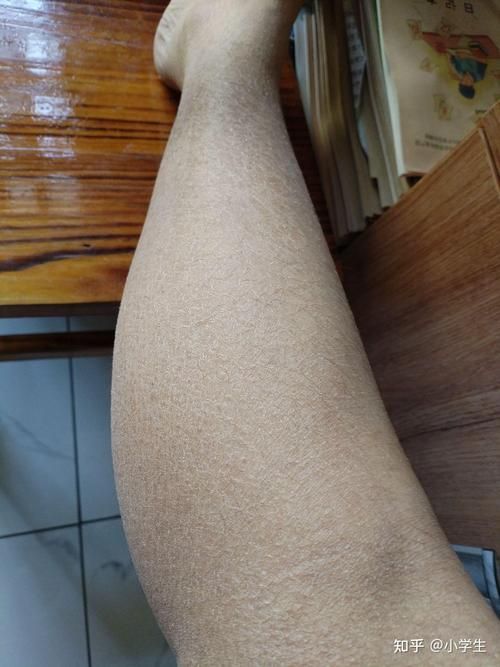 魚鱗皮膚病圖片，如何區分不同類型的魚鱗病？