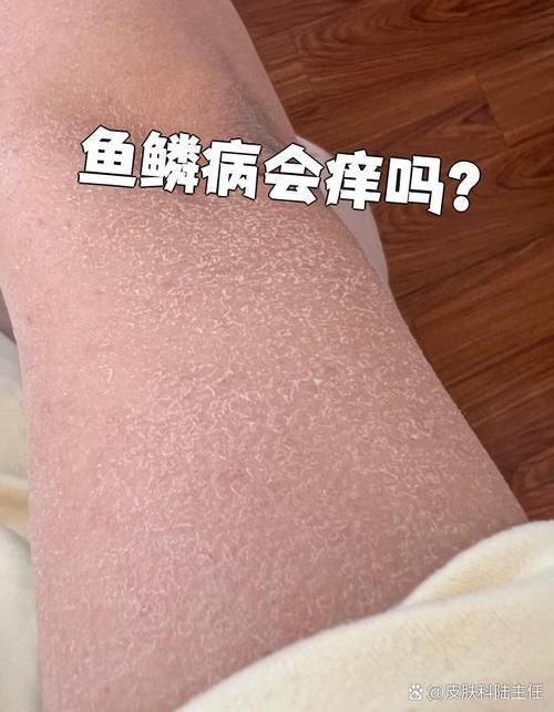 魚鱗皮膚病圖片，如何區分不同類型的魚鱗??？