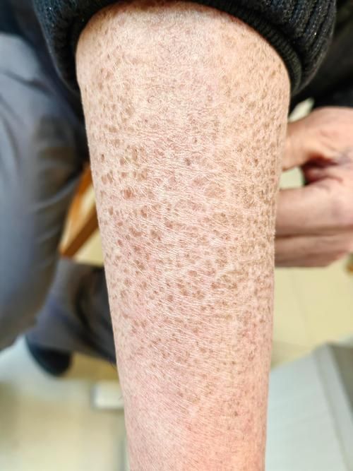 魚鱗皮膚病圖片，如何區分不同類型的魚鱗病？