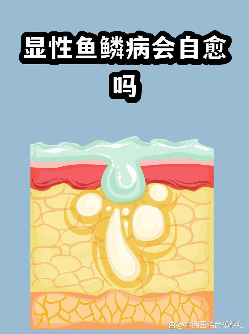 魚鱗皮膚病可以自愈嗎，魚鱗病會自愈嗎