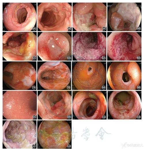 如何區分不同病因引起的腸炎，關于腸炎診斷
