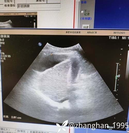 如何判斷雷龍腹水的嚴重程度，如何判斷雷龍腹水