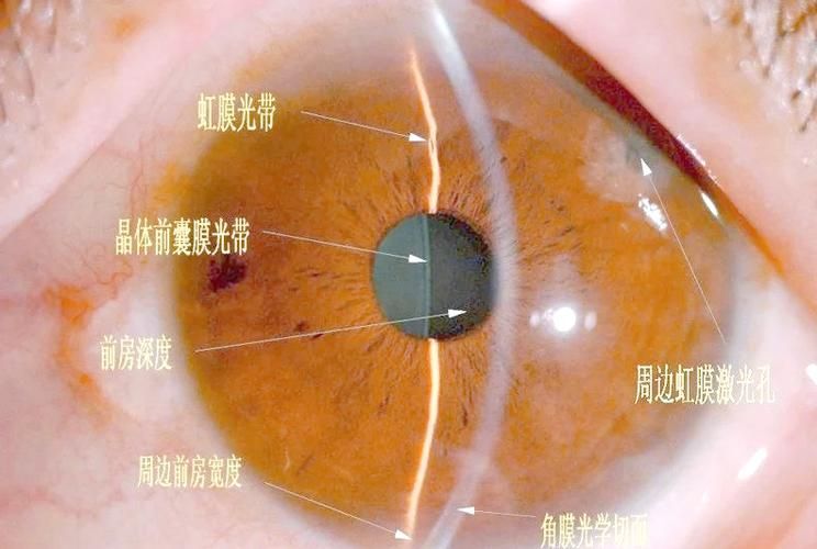 如何判斷魚眼白膜的類型，魚眼白膜的鑒別