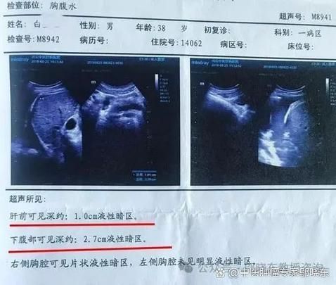 如何判斷魚腹水是否復(fù)發(fā)，百度健康-去問診（百度健康-去問診”和“百度健康-去問診” 如何判斷魚腹水是否復(fù)發(fā)，百度健康-去問診（百度健康-去問診”和“百度健康-去問診” 龍魚百科 第3張