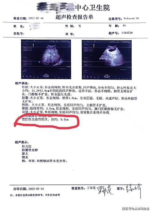如何判斷魚腹水是否復(fù)發(fā)，百度健康-去問診（百度健康-去問診”和“百度健康-去問診” 如何判斷魚腹水是否復(fù)發(fā)，百度健康-去問診（百度健康-去問診”和“百度健康-去問診” 龍魚百科 第5張