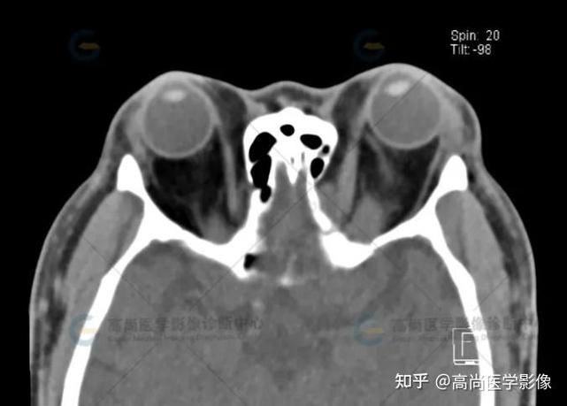 有哪些藥物可以幫助治療魚(yú)突眼，“魚(yú)突眼”的藥物治療