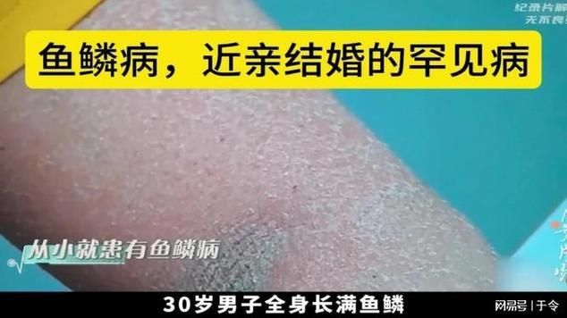 能否提供更多關(guān)于魚鱗病的圖片，如何判斷自己是否患有魚鱗病