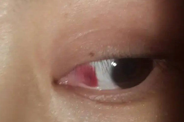 魚頭充血多久會好，“魚頭充血多久會好”
