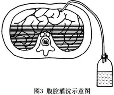 如何安全地進行腹部灌水，富媒體組件聚焦“腹部灌水”與“專業替代方案”的傳播效果