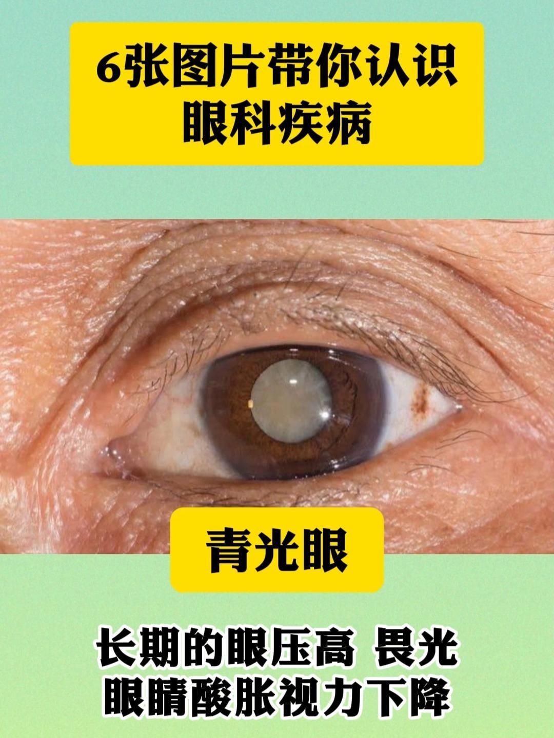 如何區分蒙眼病與其他眼部疾病，全民小視頻，如何判斷自己是否患有蒙眼病 如何區分蒙眼病與其他眼部疾病，全民小視頻，如何判斷自己是否患有蒙眼病 龍魚百科 第2張