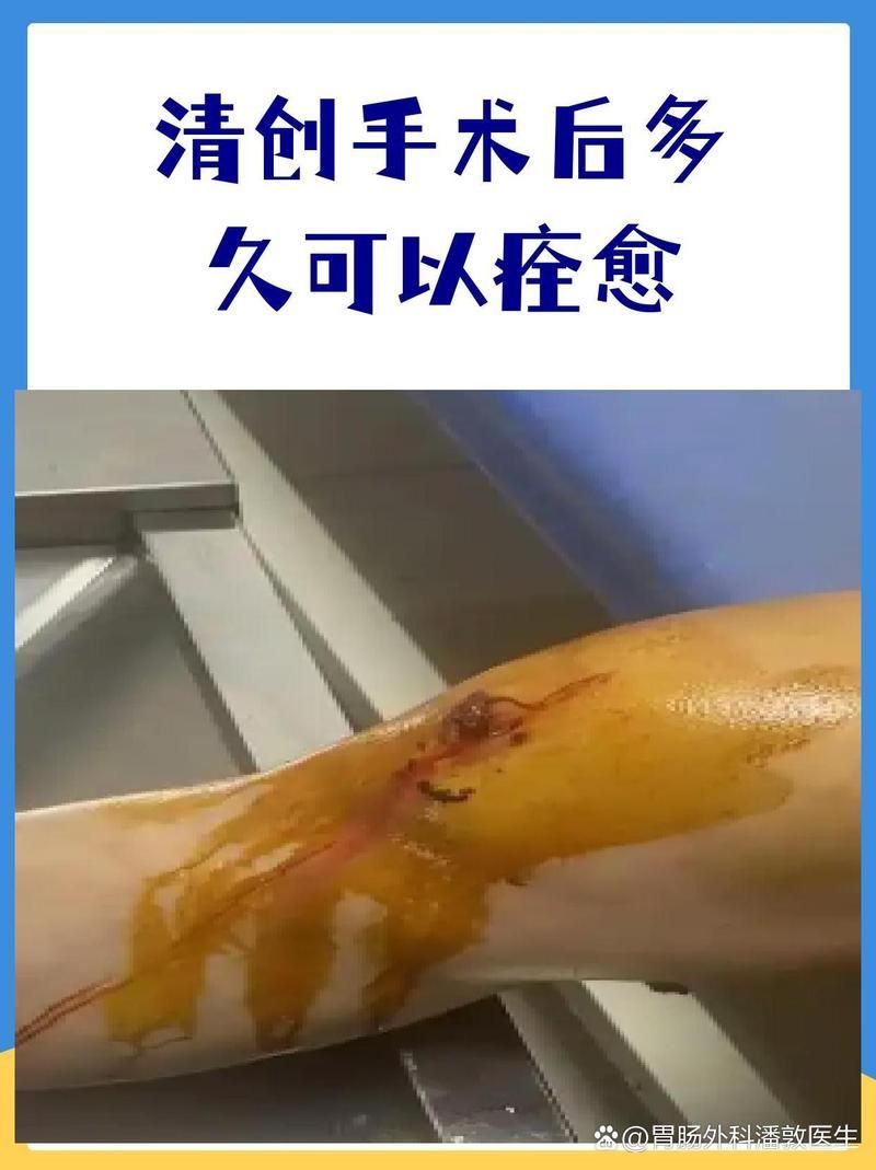 清創手術后需要多長時間恢復，清創手術后多久可以恢復正常活動 清創手術后需要多長時間恢復，清創手術后多久可以恢復正常活動 龍魚百科 第1張