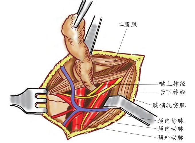 翻鰓手術(shù)風(fēng)險(xiǎn)大嗎，百度健康-去問診,
