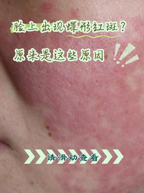 紅斑病和赤皮病如何治療，關于紅斑病（剝脫性皮炎）