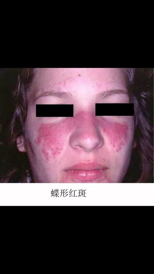 紅斑病和赤皮病如何治療，關于紅斑病（剝脫性皮炎）