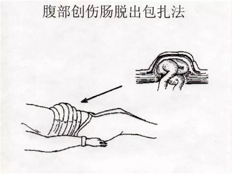腹部外傷有內(nèi)臟脫出時，腹部外傷內(nèi)臟脫出處理示意圖，現(xiàn)場包扎，盡快送醫(yī)