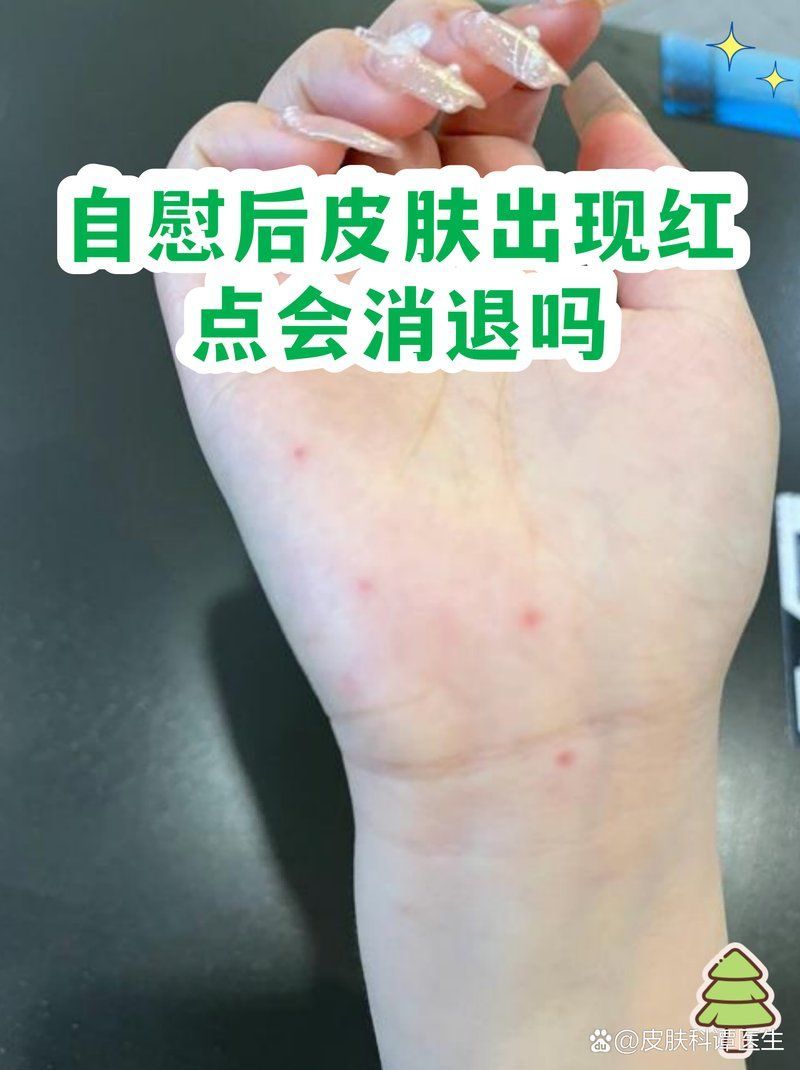 生理性紅點(diǎn)會(huì)自行消失嗎，性紅點(diǎn)會(huì)自行消失嗎？ 生理性紅點(diǎn)會(huì)自行消失嗎，性紅點(diǎn)會(huì)自行消失嗎？ 龍魚(yú)百科 第1張