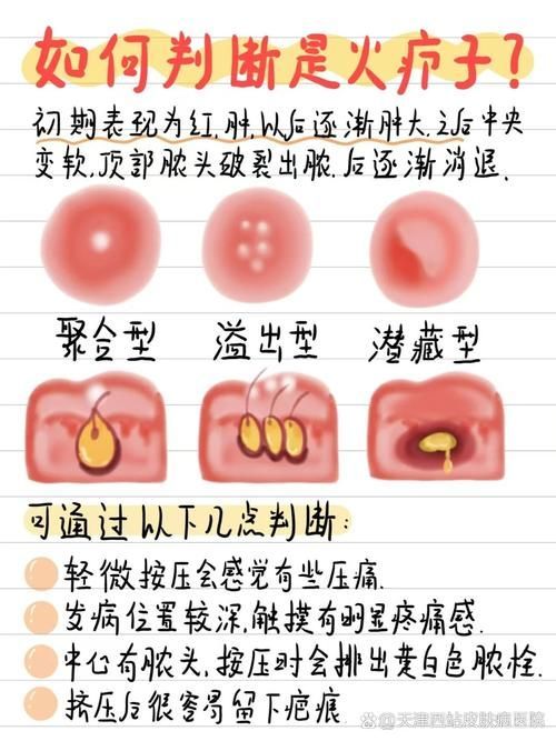 真菌和細(xì)菌感染的治療方法有哪些