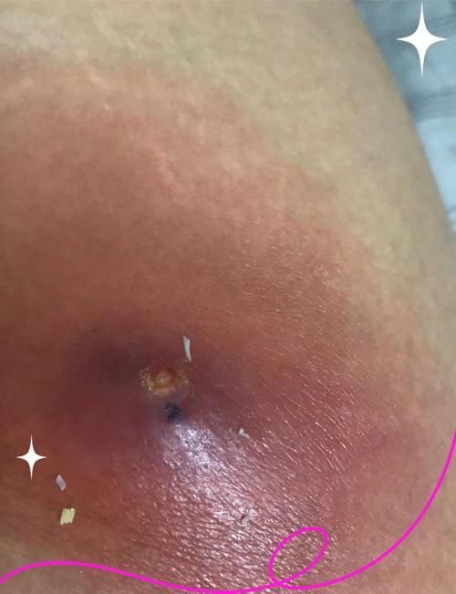真菌和細(xì)菌感染的治療方法有哪些