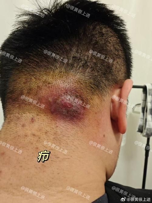 真菌和細(xì)菌感染的治療方法有哪些