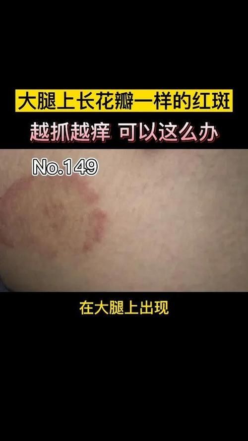 真菌和細菌感染的治療方法有哪些