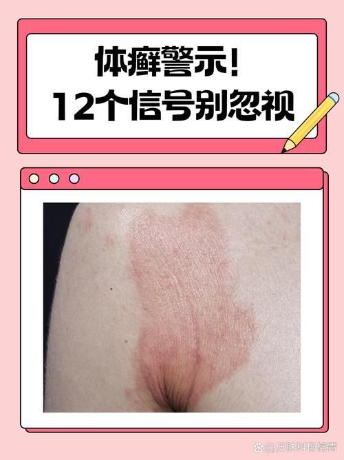 真菌和細(xì)菌感染的治療方法有哪些