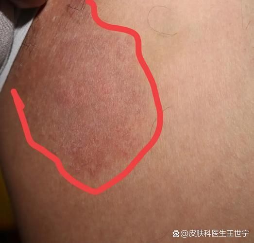 真菌和細(xì)菌感染的治療方法有哪些