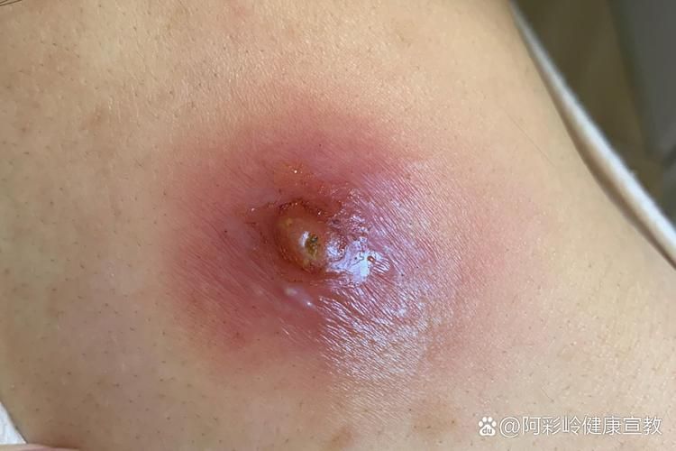 真菌和細(xì)菌感染的治療方法有哪些