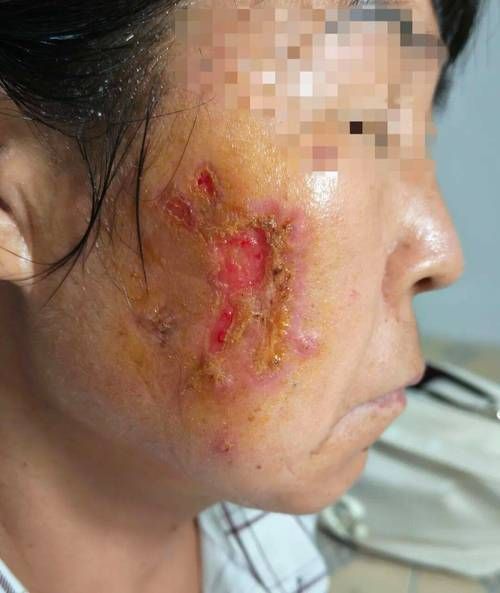 如何判斷海水細(xì)菌感染的嚴(yán)重程度，如何判斷海水細(xì)菌感染