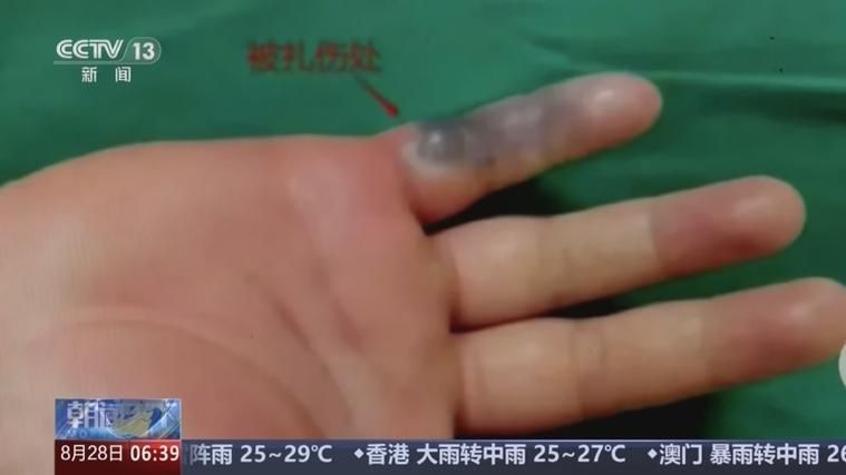 海洋弧菌感染早期圖片，感染海洋弧菌后多久會出現癥狀 海洋弧菌感染早期圖片，感染海洋弧菌后多久會出現癥狀 龍魚百科 第8張