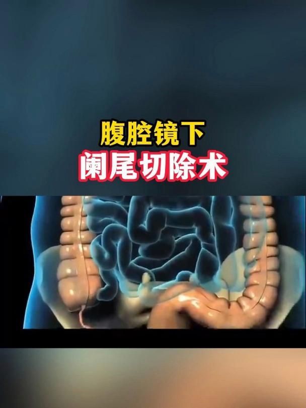 能否提供腹腔鏡闌尾切除術的動態演示，腹腔鏡闌尾切除術全過程嗶哩嗶哩嗶哩嗶哩嗶哩嗶哩