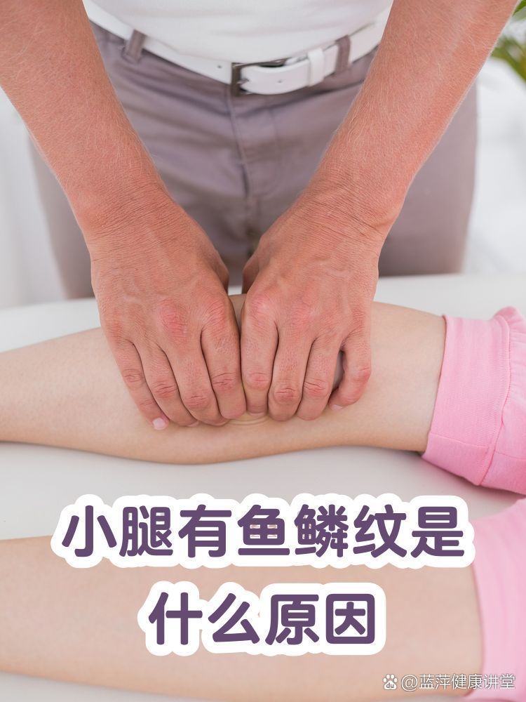 小腿魚鱗紋會自行緩解嗎，小腿魚鱗紋會自行消失嗎 小腿魚鱗紋會自行緩解嗎，小腿魚鱗紋會自行消失嗎 龍魚百科 第2張